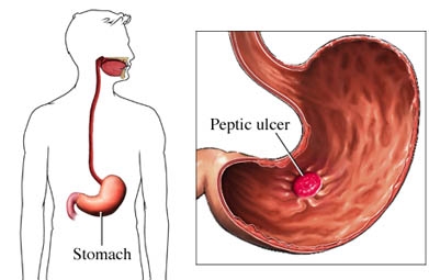 Ulcerul gastric si duodenal (gastric)